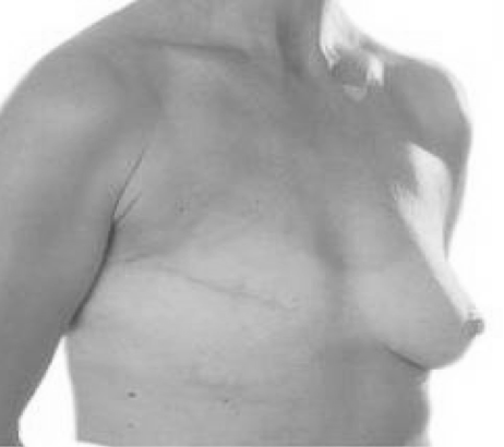 Mastectomía Simple